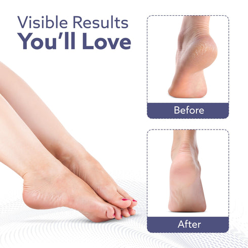 Callus Remover Replaceable Heads, 2 Pcs, Callus & Dead Skin Removal Filer, Pedicure at Home