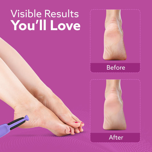 CR1414 Electric Callus Remover with 2 Replaceable Heads – Rechargeable Foot Scrubber for Dead Skin & Cracked Heels | Pedicure Machine with 120 Minutes Runtime