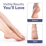 Callus Remover Replaceable Heads, 2 Pcs, Callus & Dead Skin Removal Filer, Pedicure at Home